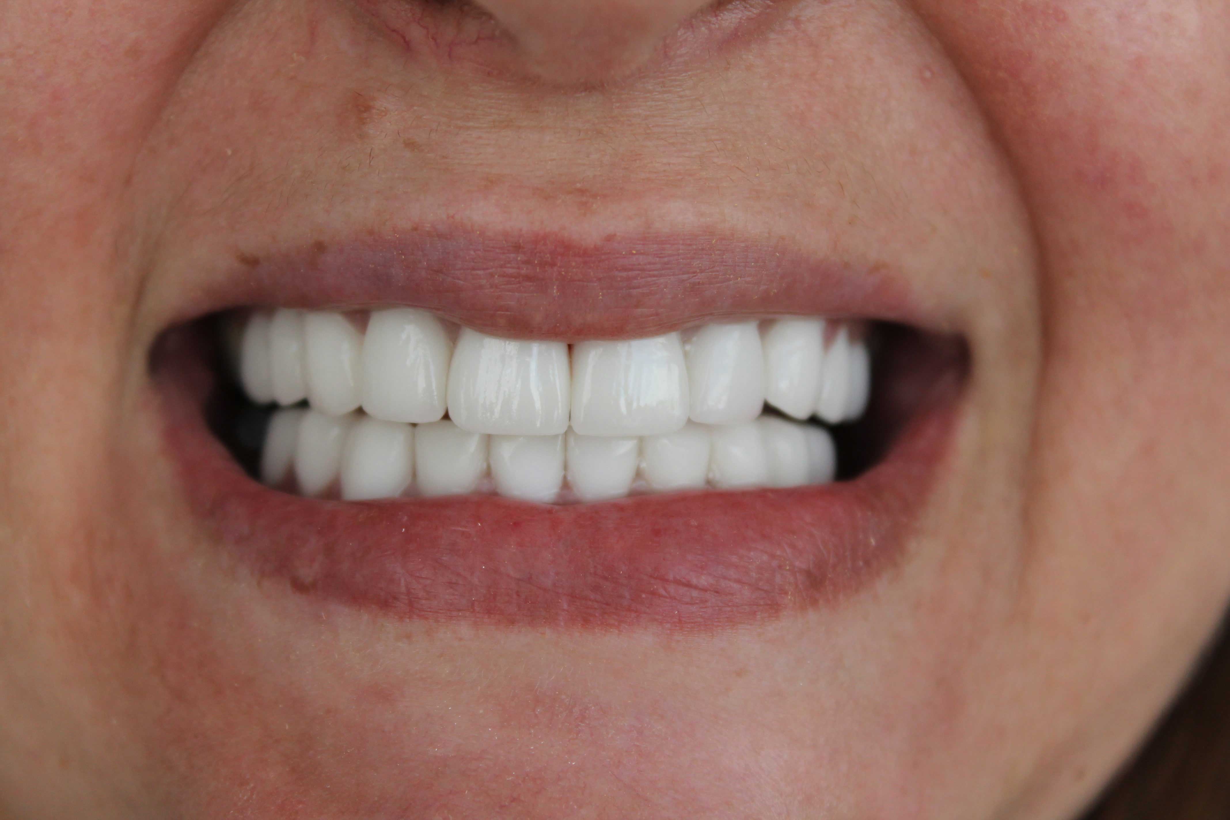 Admira-After-min admira after