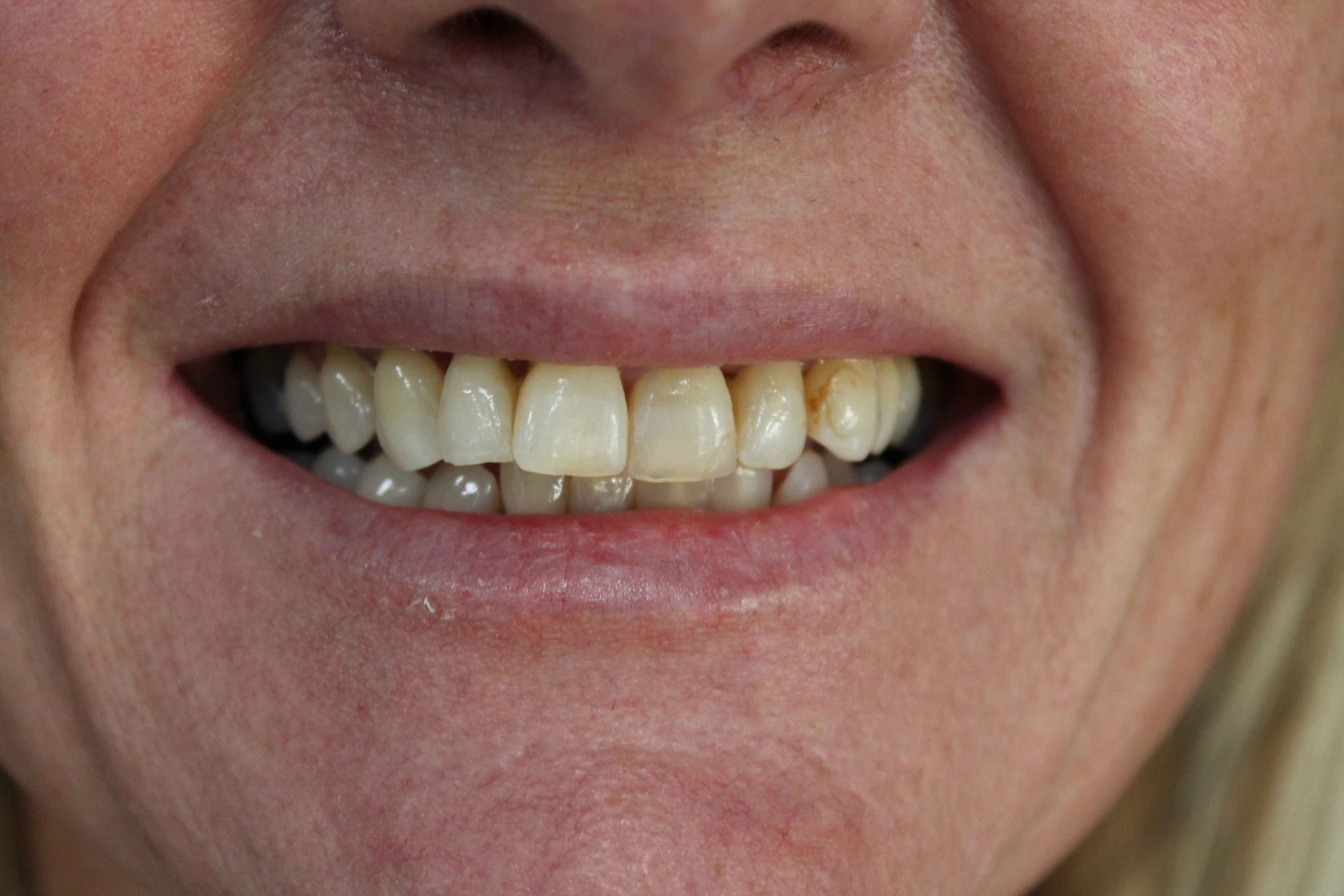 Alison-Before-min Alison Before-