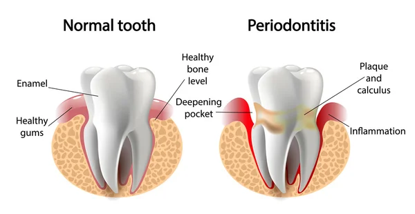 Symptoms of Periodontal (gum) Disease
