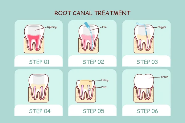 How Make is Root Treatment?