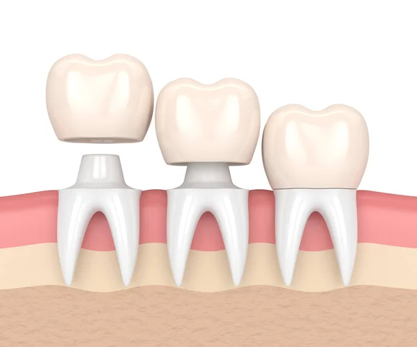 What is a Dental Crown in Turkey?