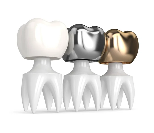 Types of Dental Crowns in Turkey