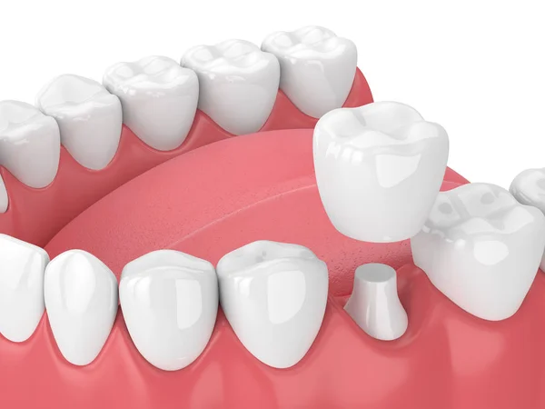 Reasons for Dental Crowns in Turkey?
