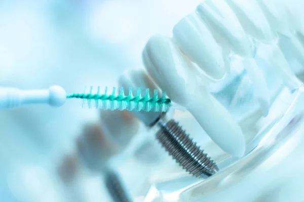 Mini Dental Implants In Turkey