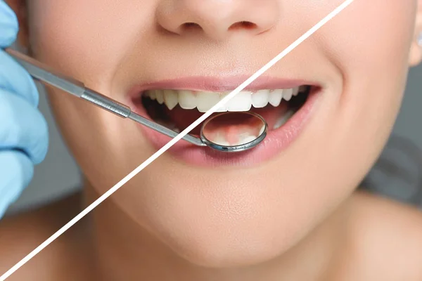 Teeth Whitening Procedures, Methods and Types Step By Step