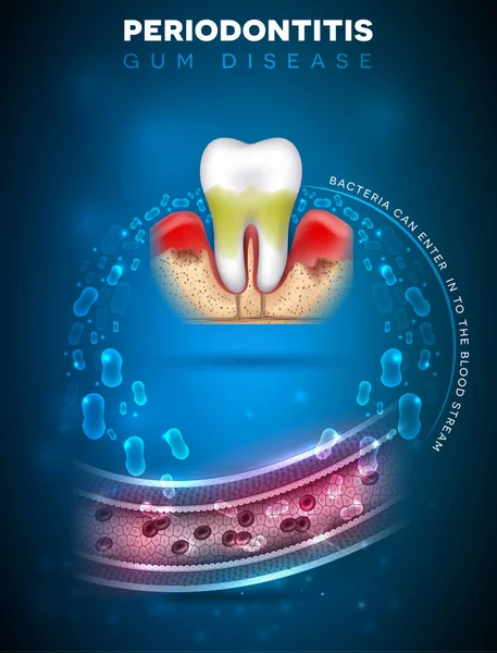 Periodontal (gum) Disease Prevention