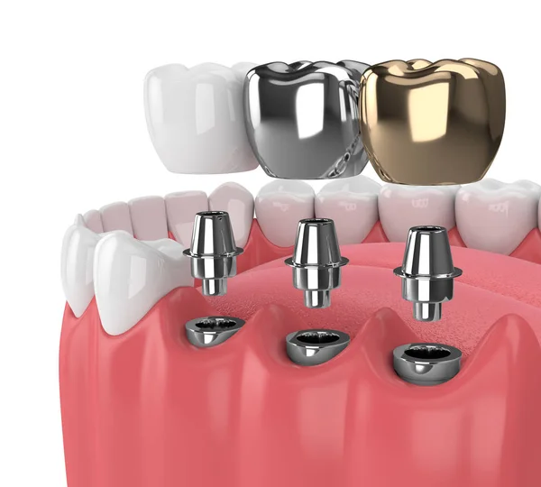 Types of dental implants