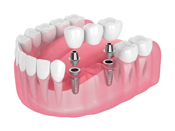 Dental Implant Bridge In Turkey