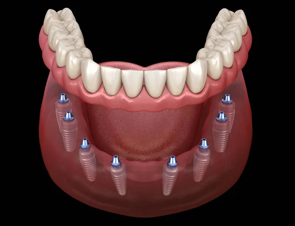 All On 8 Dental Implants In Turkey