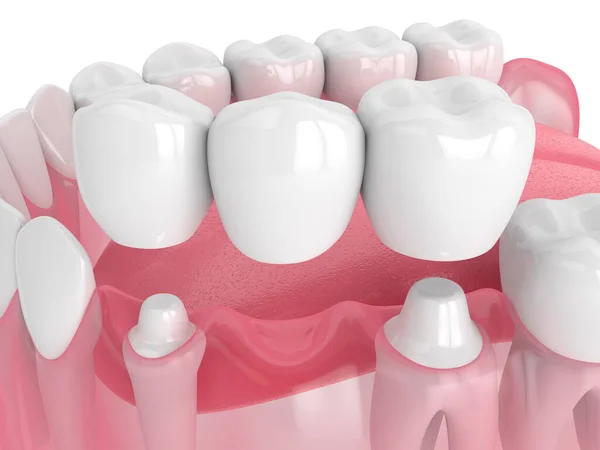Dental Crowns and Bridges