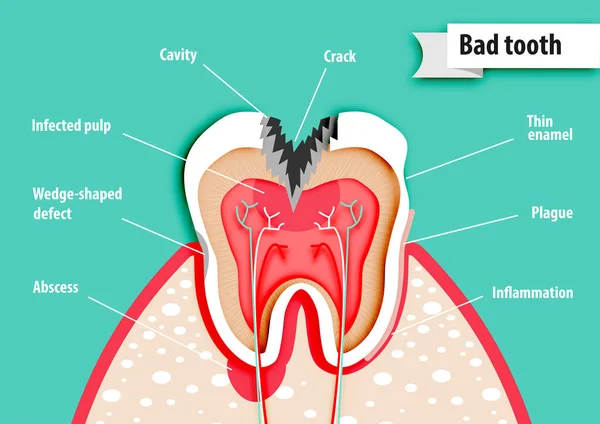 Root Canal Treatment Symptoms and Causes
