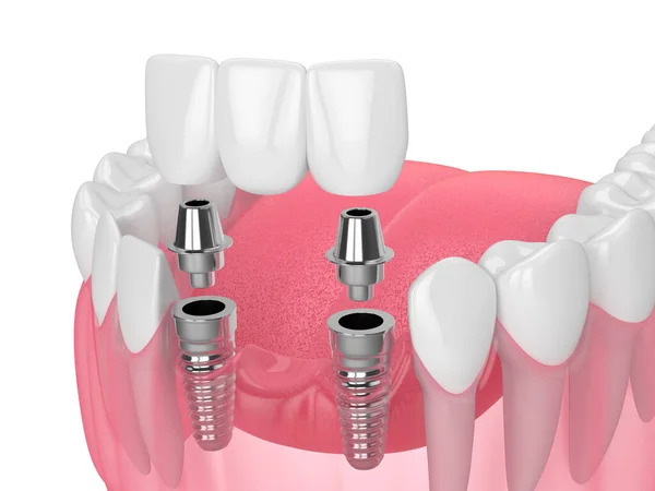 Dental Implant Bridge