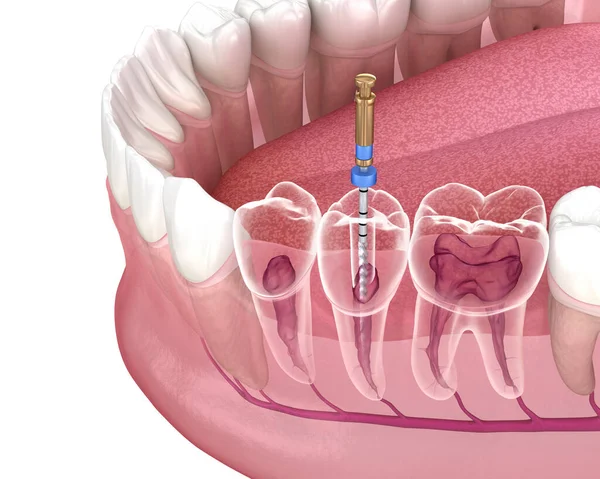 What Are The Care Recommendations After Root Canal Treatment?