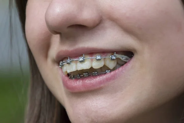 Hollywood Smile With Orthodontic Treatments