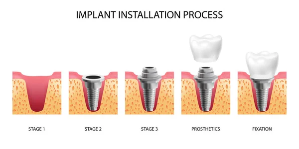 Implant Treatment Stages in Turkey Step by Step