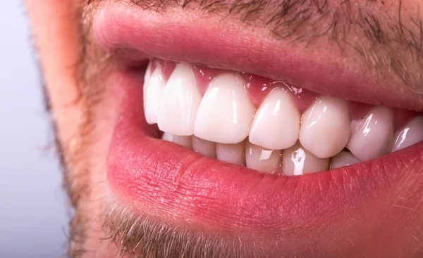 Post Treatment Dental How to Care for Implants ?