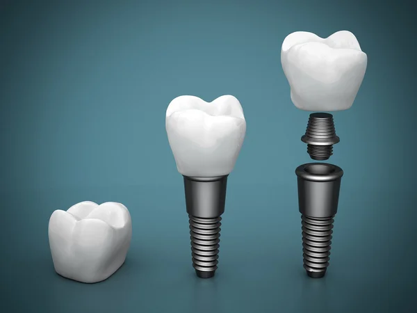 Dental Implants turkey