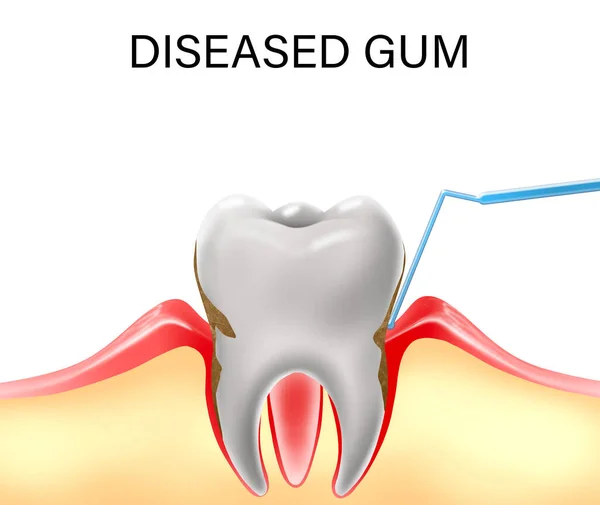 Risk Factors For Periodontal (gum) Disease Treatment