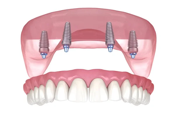 All On Four Dental Implants In Turkey