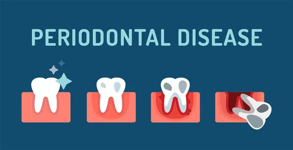 What is Periodontal (Gum) Disease?